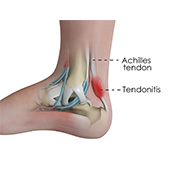 Achilles Tendinitis