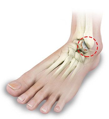 Foot and Ankle Arthritis