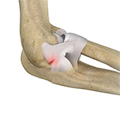 Lateral Ulnar Collateral Ligament Injuries (Elbow)