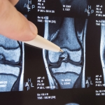 What You Need to Know Before Getting Knee Replacement Surgery
